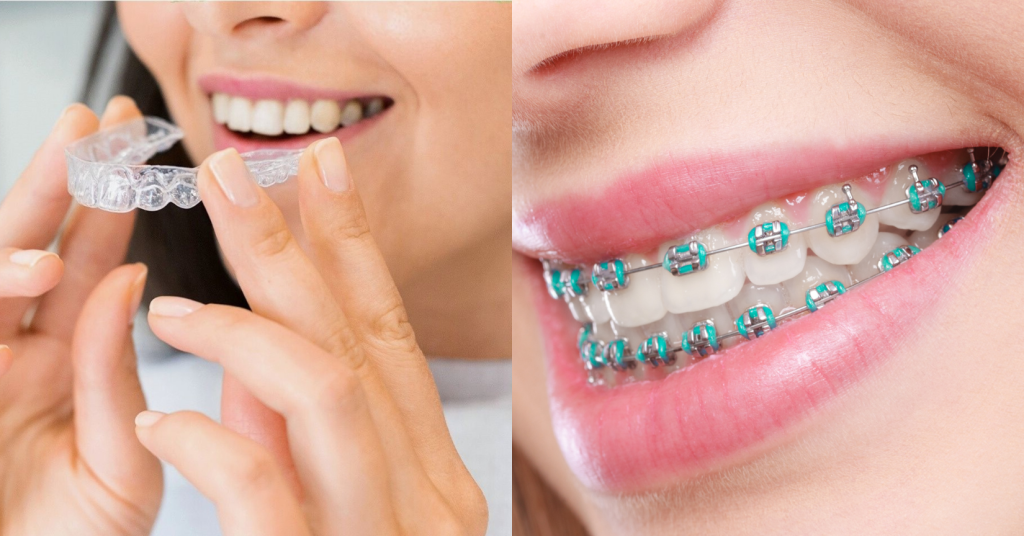 traditional braces and invisalign